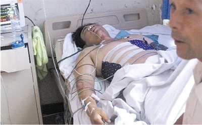 年纪大些的王玉春右胸上也能明显地看到被轧的痕迹。